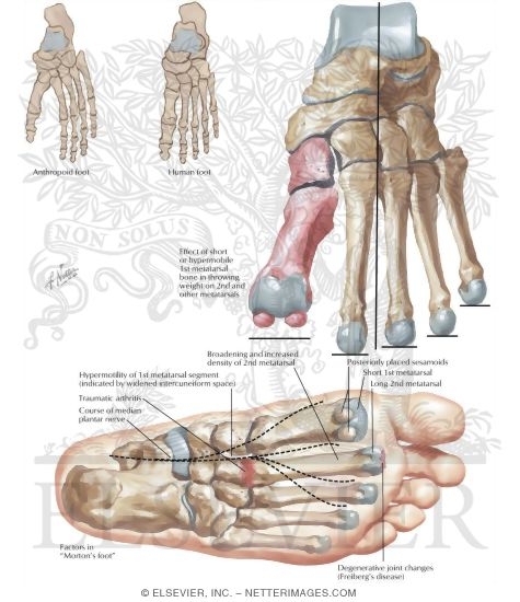 Comparison of Anthropoid and Human Foot - Morton's Foot