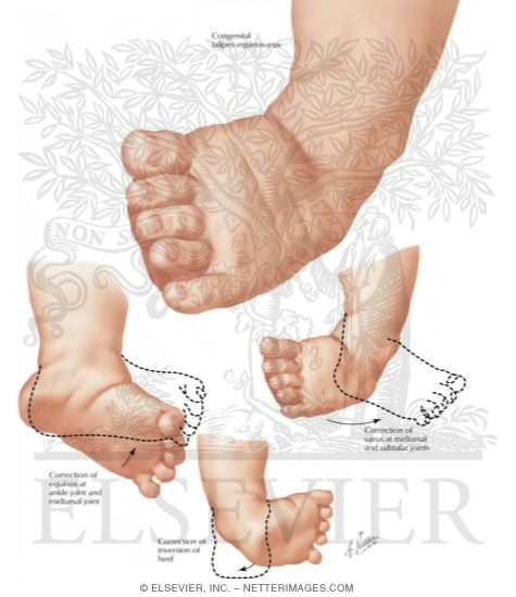 Talipes Equinovarus