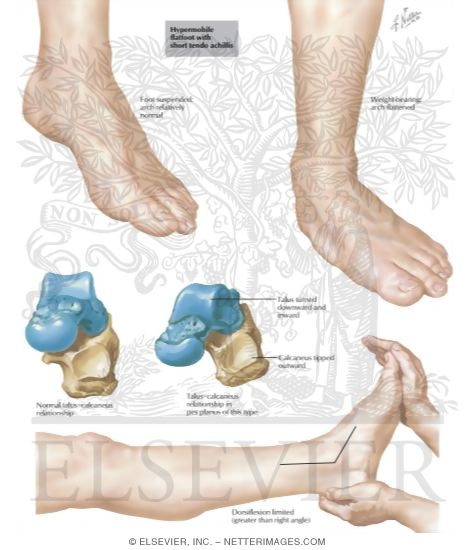 Watermarked preview of labeled image: Hypermobile Flatfoot