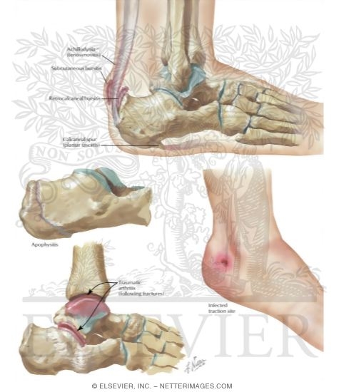 Watermarked preview of labeled image: Disorders of Heel