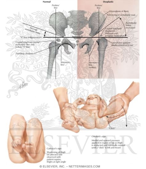 Watermarked preview of labeled image: Signs of Hip Dislocation