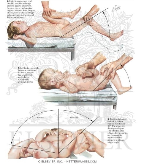 Watermarked preview of labeled image: Iliopsoatic Reinforced Tension Signs I