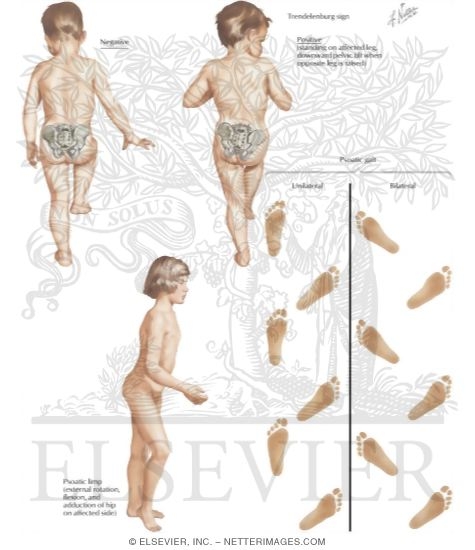 Watermarked preview of labeled image: Iliopsoas Syndromes