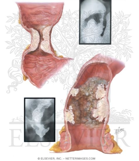 Watermarked preview of unlabeled image: Malignant Lesion of Colon