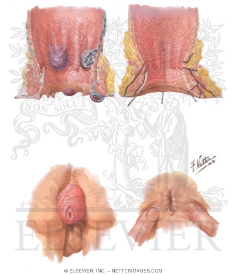 Hemorrhoids