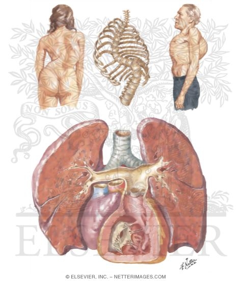 Kyphoscoliosis, Pathology