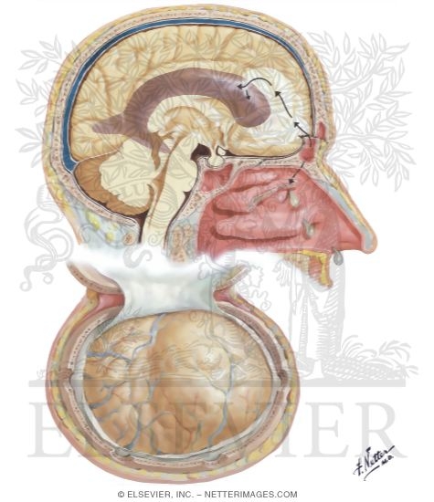 Watermarked preview of unlabeled image: Traumatic Pneumocephalus