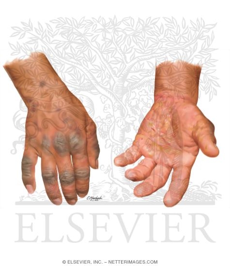 Pictures of contact dermatitis rash picture