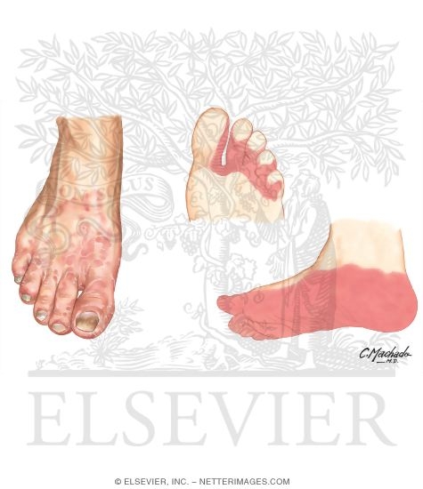 Diagnosis of Tinea Pedis