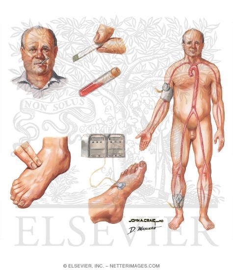 Watermarked preview of unlabeled image: Clinical Evaluation of Patient With Diabetic Foot Lesion