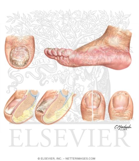 Clinical Examples of Onychomycoses: Distal and Lateral Subungual Onychomycosis