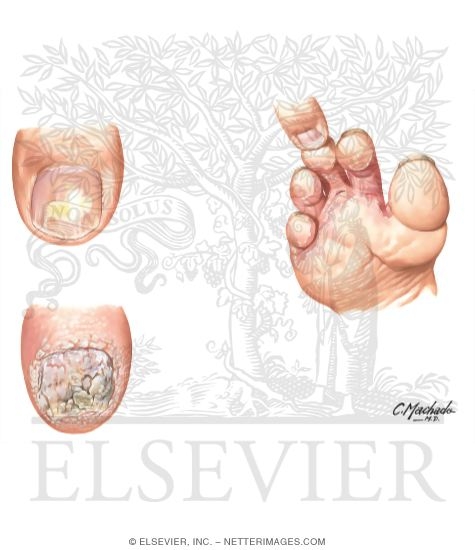 Watermarked preview of unlabeled image: Clinical Examples of Onychomycosis