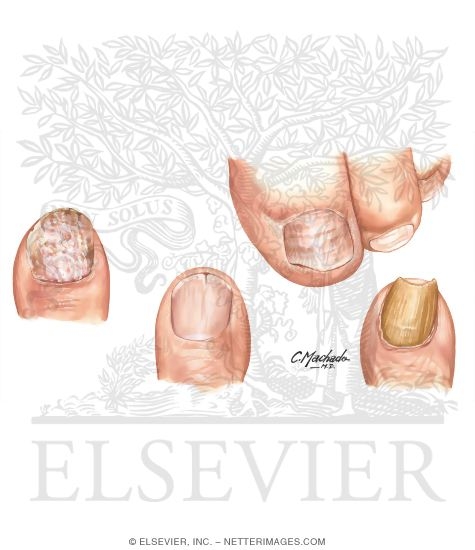 Watermarked preview of unlabeled image: Conditions That Mimic Toenail Fungus