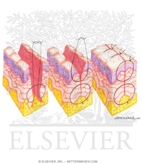 Watermarked preview of unlabeled image: Wound Closure: an Acceptable Technique