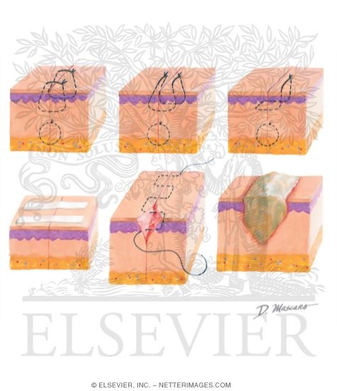Watermarked preview of unlabeled image: Methods of Wound Closure