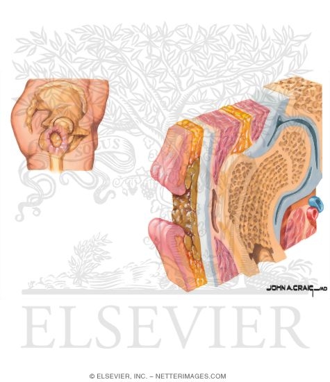 Watermarked preview of unlabeled image: Evolution of a Pressure Ulcer: Early Deep Ulceration