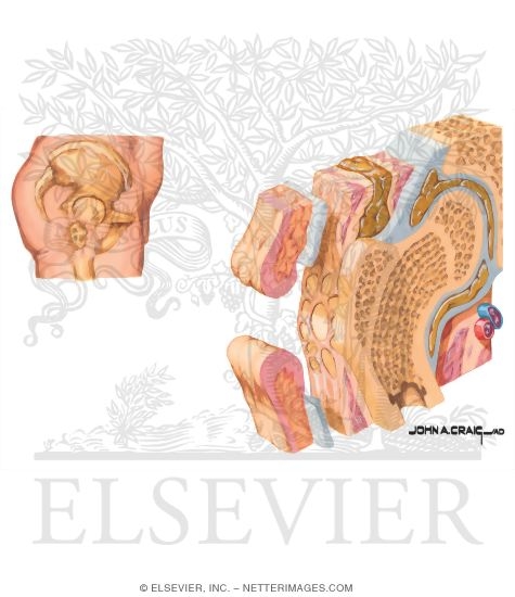 Watermarked preview of unlabeled image: Evolution of a Pressure Ulcer: Late Deep Ulceration