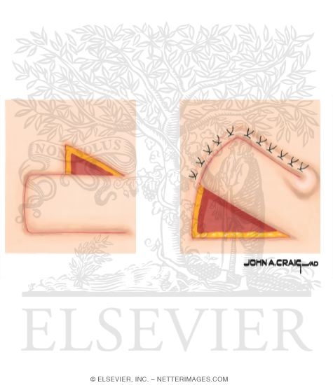 Watermarked preview of unlabeled image: Skin Flap Design (Transposition Flap)