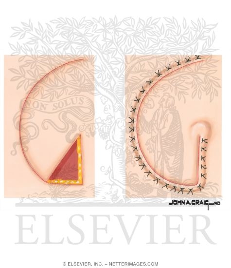 Skin Flap Design (Rotation Flap)