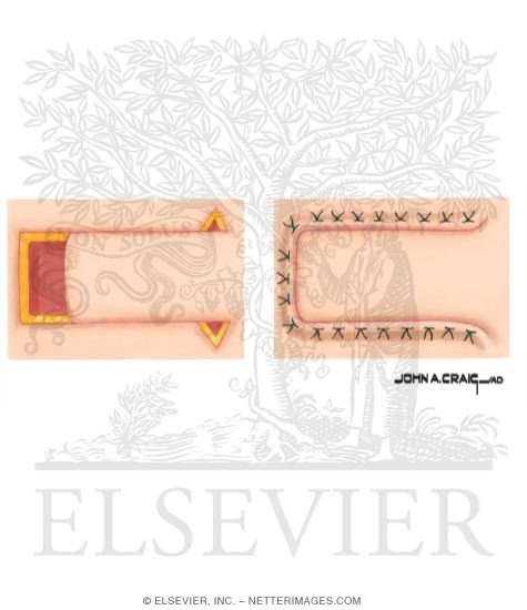 Skin Flap Design (Advancement Flap)