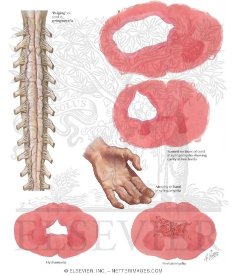 Syringomyelia, Hematomyelia and Hydromyelia