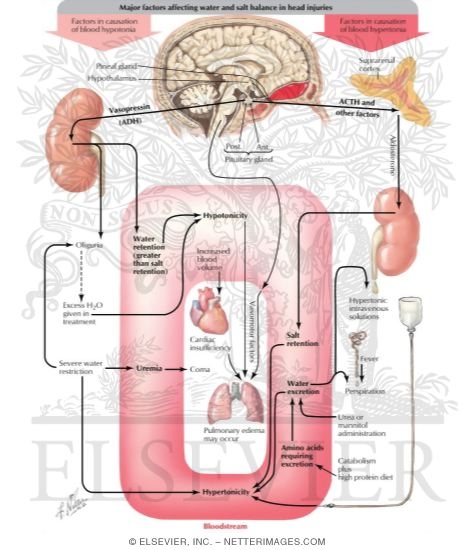 Watermarked preview of labeled image: Salt and Water Balance In Head Injury