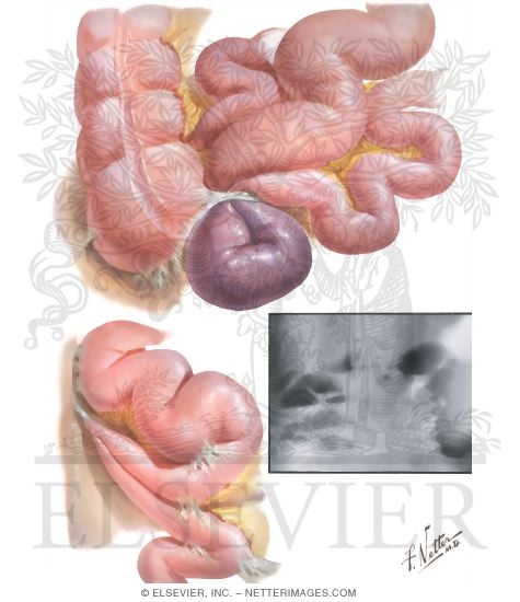 Intestinal Obstruction