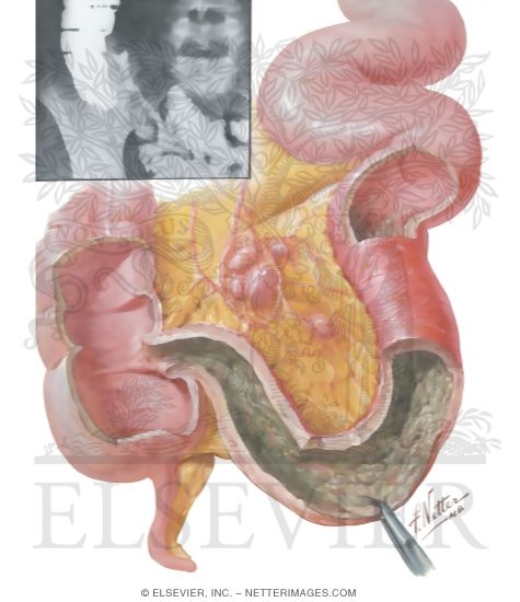 Regional Enteritis