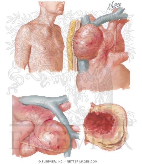Watermarked preview of unlabeled image: Surgery of Aorta