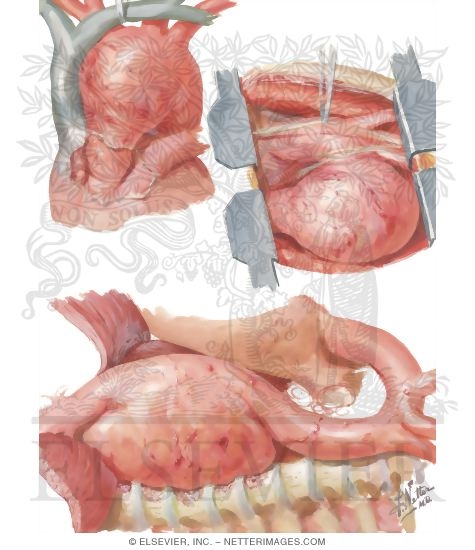 Watermarked preview of unlabeled image: Surgery of Aorta