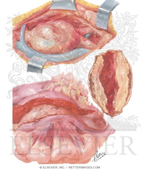 Watermarked preview of unlabeled image: Surgery of Aorta