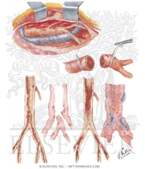 Watermarked preview of unlabeled image: Surgery of Aorta