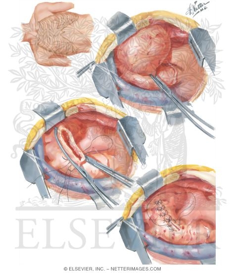 Surgery Of Aorta