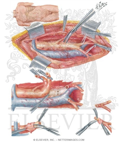 Watermarked preview of unlabeled image: Surgery of Aorta