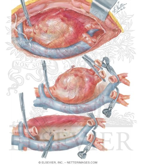Watermarked preview of unlabeled image: Surgery of Aorta