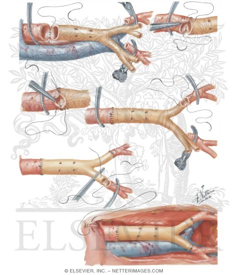 Watermarked preview of unlabeled image: Surgery of Aorta