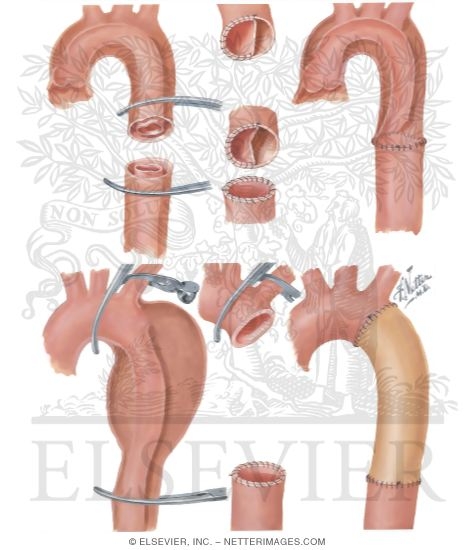 Watermarked preview of unlabeled image: Surgery of Aorta