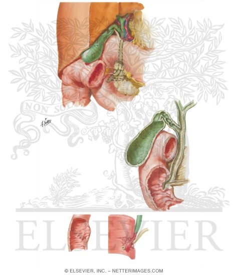 Watermarked preview of unlabeled image: Gallbladder, Extrahepatic Bile Ducts, and Pancreatic Duct