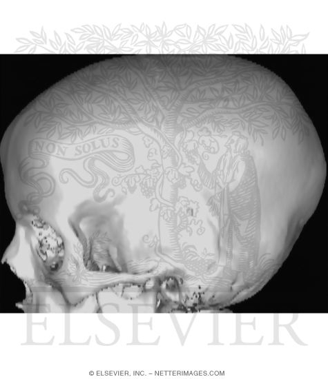 3D CT Scan of Left Lateral Skull
