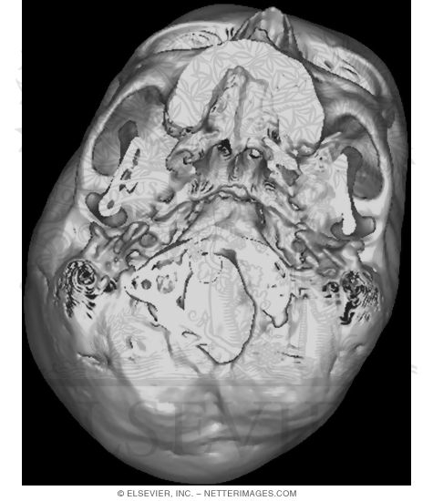 3D CT Scan of Skull Base