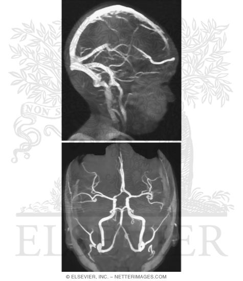 Cranial Imaging (MRV and MRA)