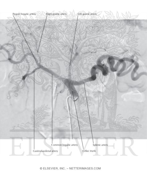 Celiac Arteriogram