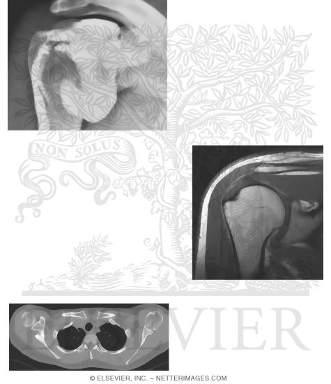Shoulder Arthrogram, MRI and CT