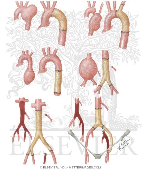Surgery of Aorta