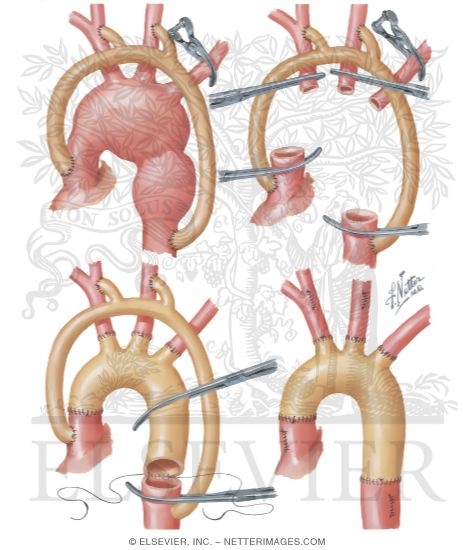 Watermarked preview of unlabeled image: Surgery of Aorta