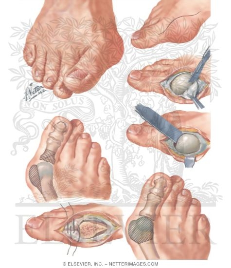 Watermarked preview of unlabeled image: Operations for Hallux Valgus