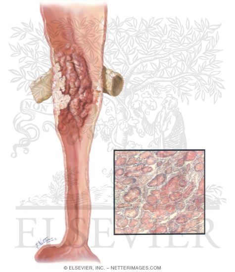 Watermarked preview of unlabeled image: Carcinoma of Esophagus