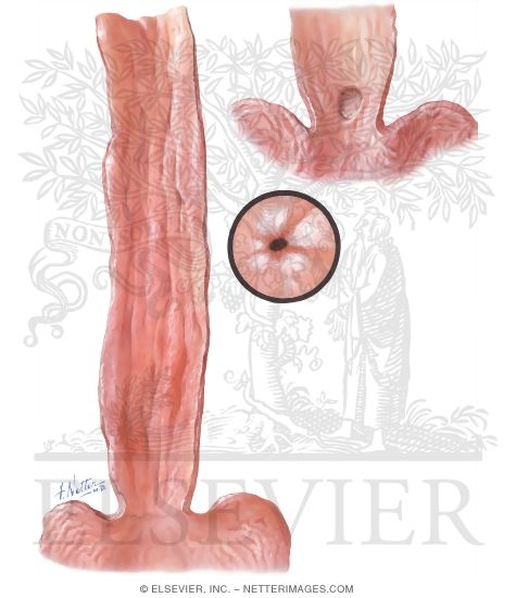 Esophagitis and Peptic Ulcer of Esophagus