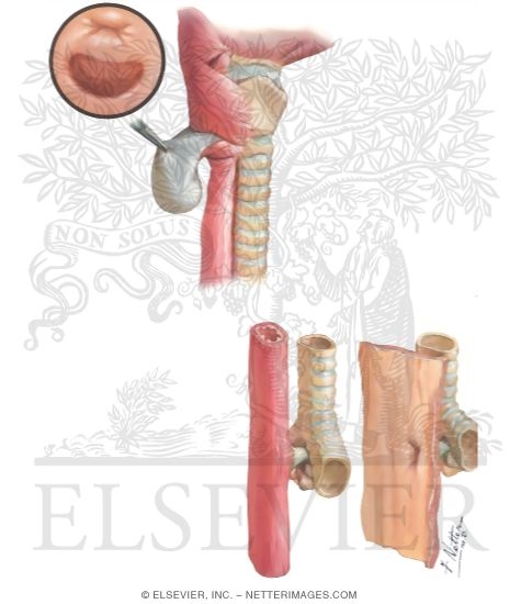 Watermarked preview of unlabeled image: Diverticula of Esophagus