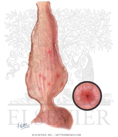 Cardiospasm